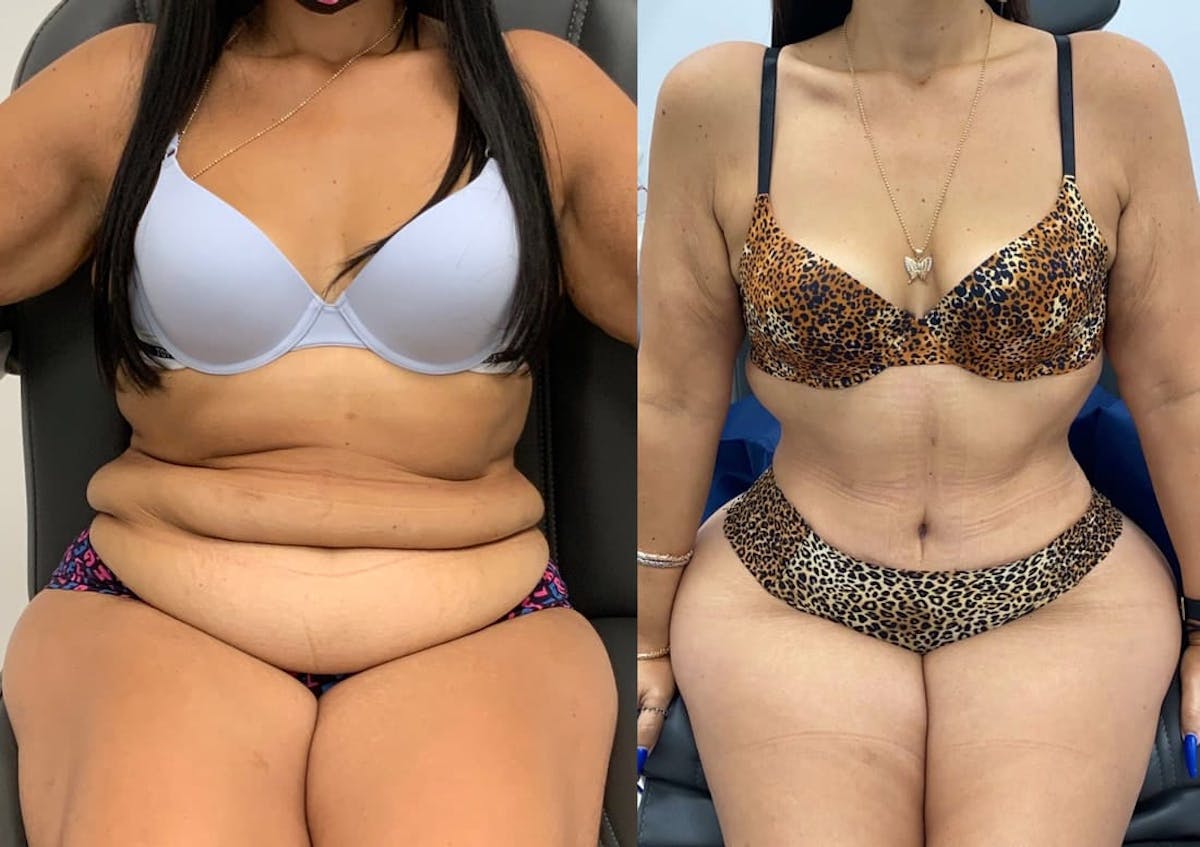 Tummy Tuck Before & After Gallery - Patient 238985 - Image 3