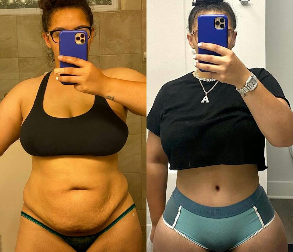 Tummy Tuck Before & After Gallery - Patient 324923 - Image 1