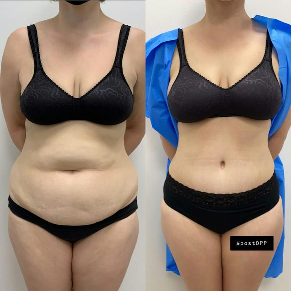 Tummy Tuck Before & After Gallery - Patient 322428 - Image 1