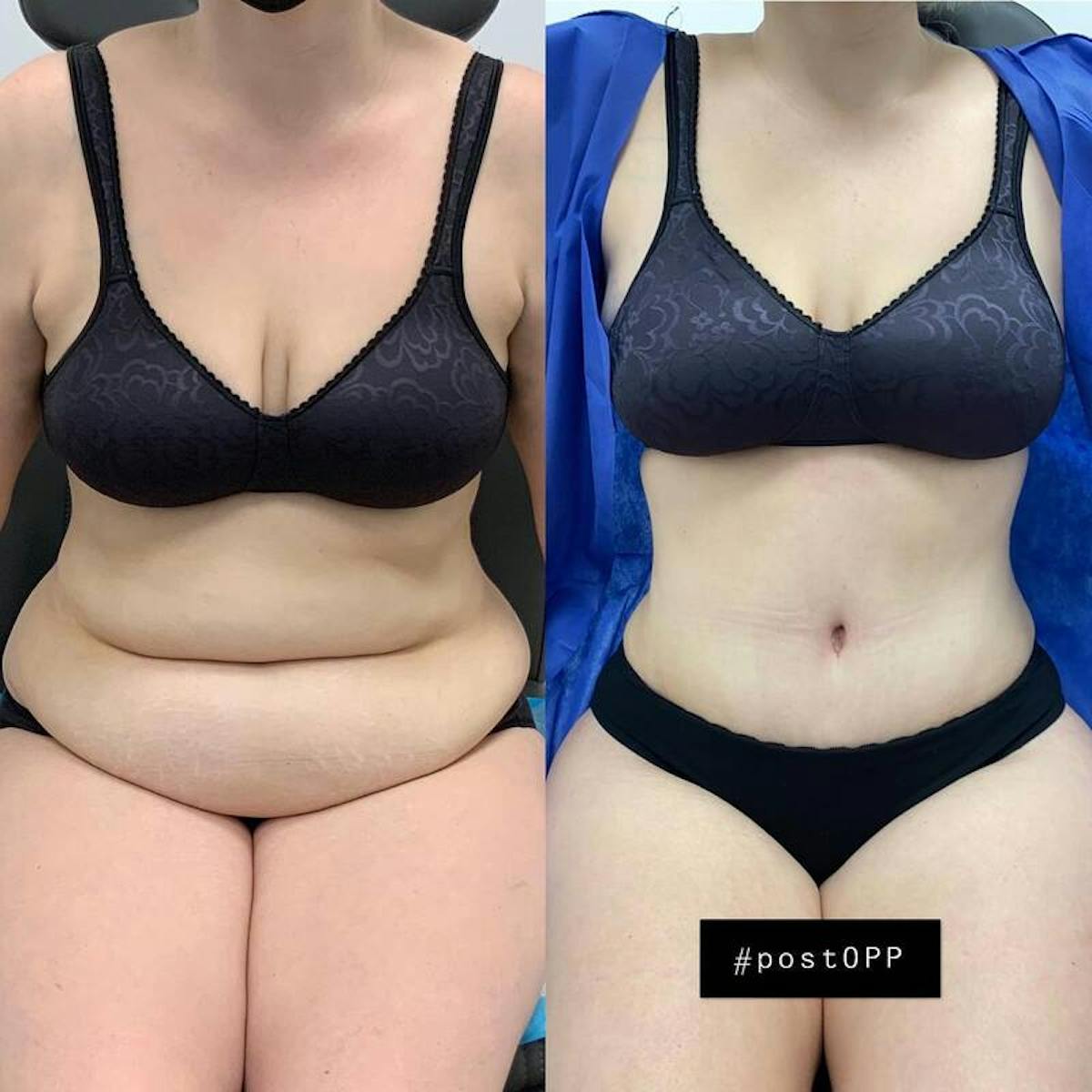 Tummy Tuck Before & After Gallery - Patient 322428 - Image 2