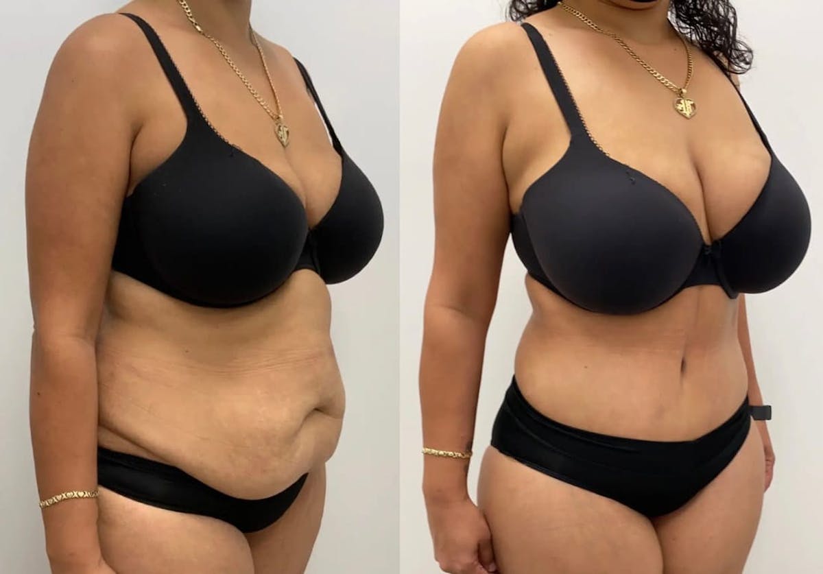 Tummy Tuck Before & After Gallery - Patient 895764 - Image 1