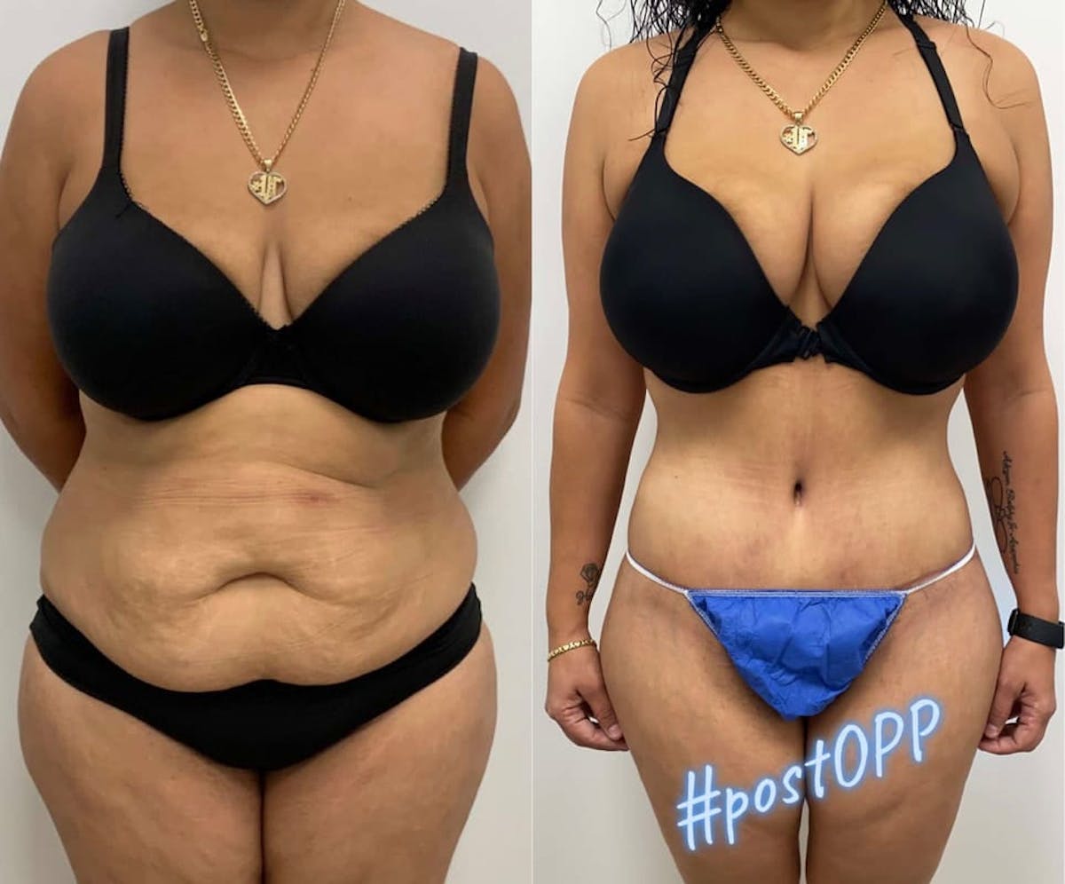 Tummy Tuck Before & After Gallery - Patient 895764 - Image 2