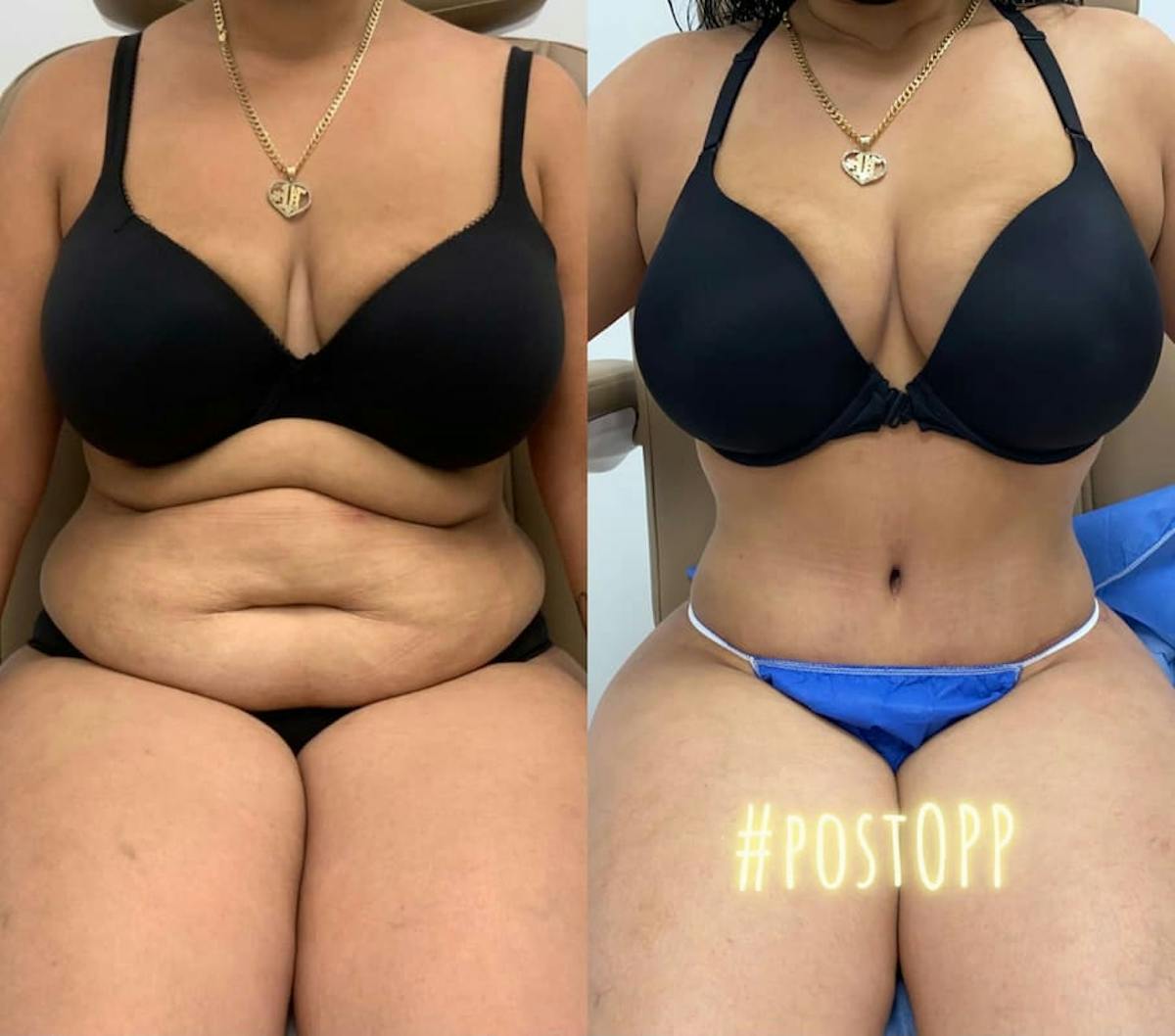 Tummy Tuck Before & After Gallery - Patient 895764 - Image 3