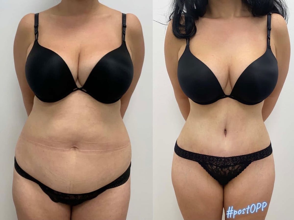 Tummy Tuck Before & After Gallery - Patient 685640 - Image 1