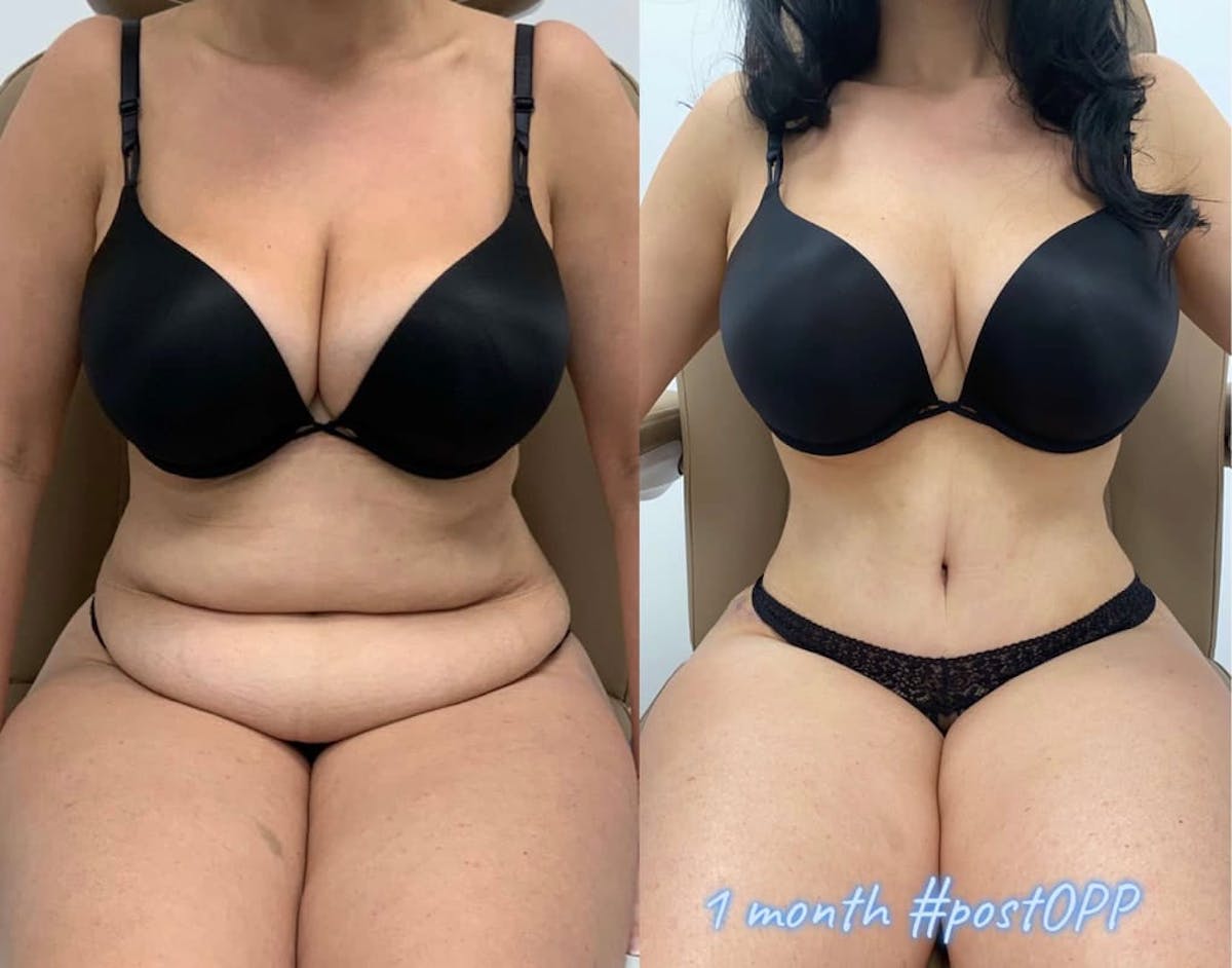 Tummy Tuck Before & After Gallery - Patient 685640 - Image 2
