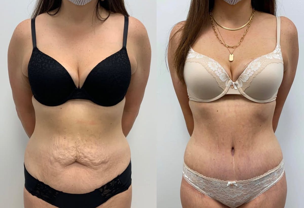 Tummy Tuck Before & After Gallery - Patient 844344 - Image 1