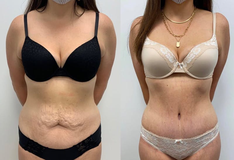Tummy Tuck Before & After Gallery - Patient 844344 - Image 1