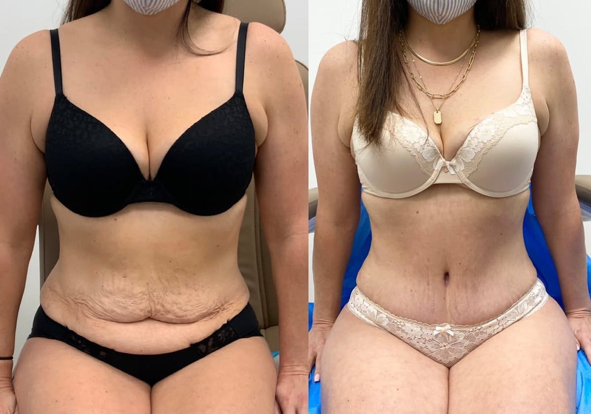 Tummy Tuck Before & After Gallery - Patient 844344 - Image 2