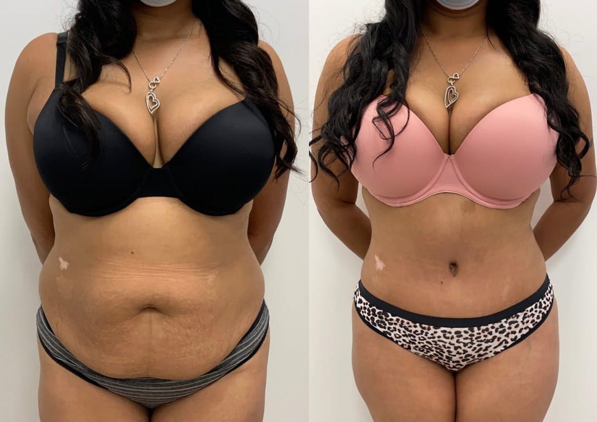 Tummy Tuck Before & After Gallery - Patient 134764 - Image 1
