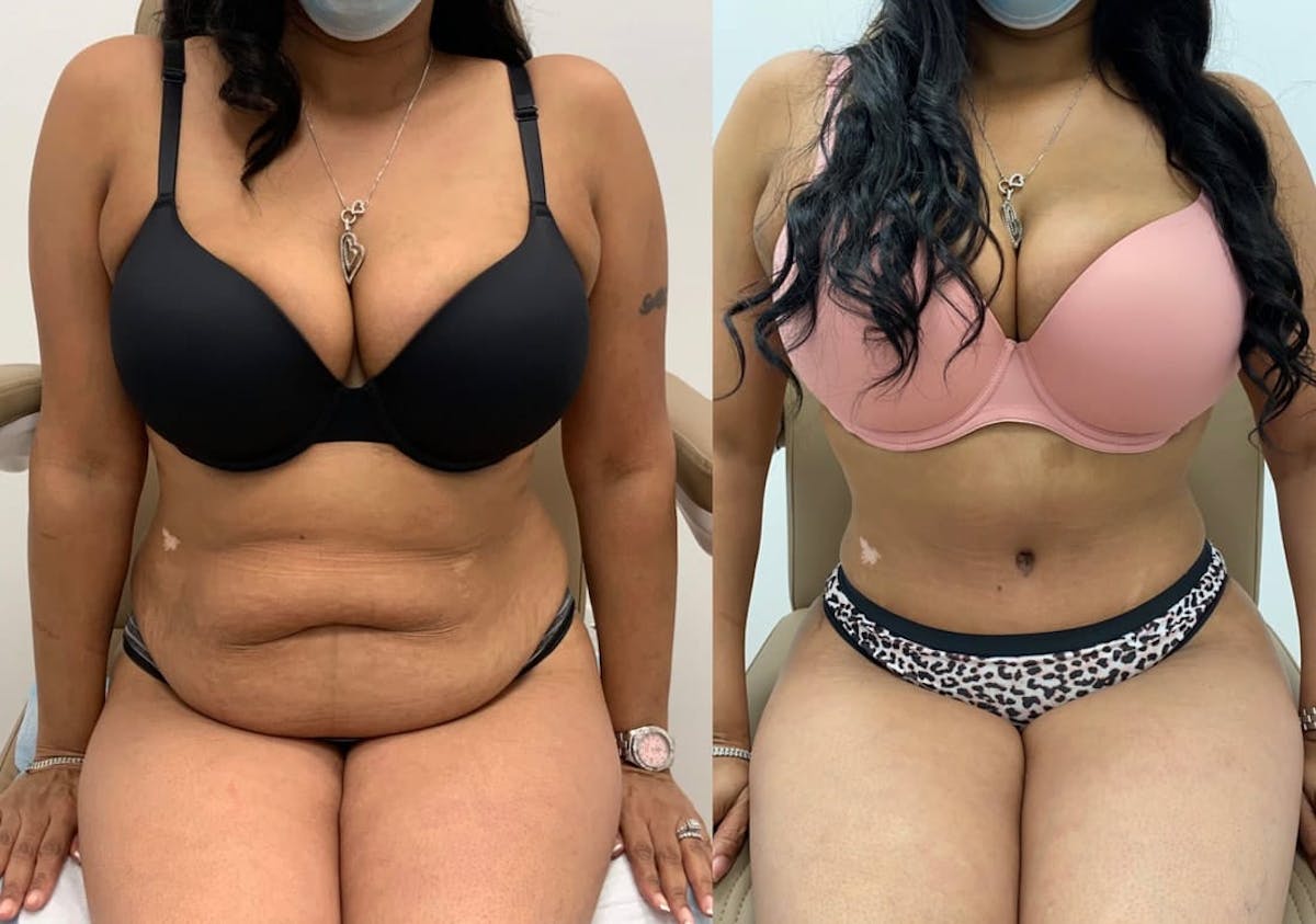 Tummy Tuck Before & After Gallery - Patient 134764 - Image 2