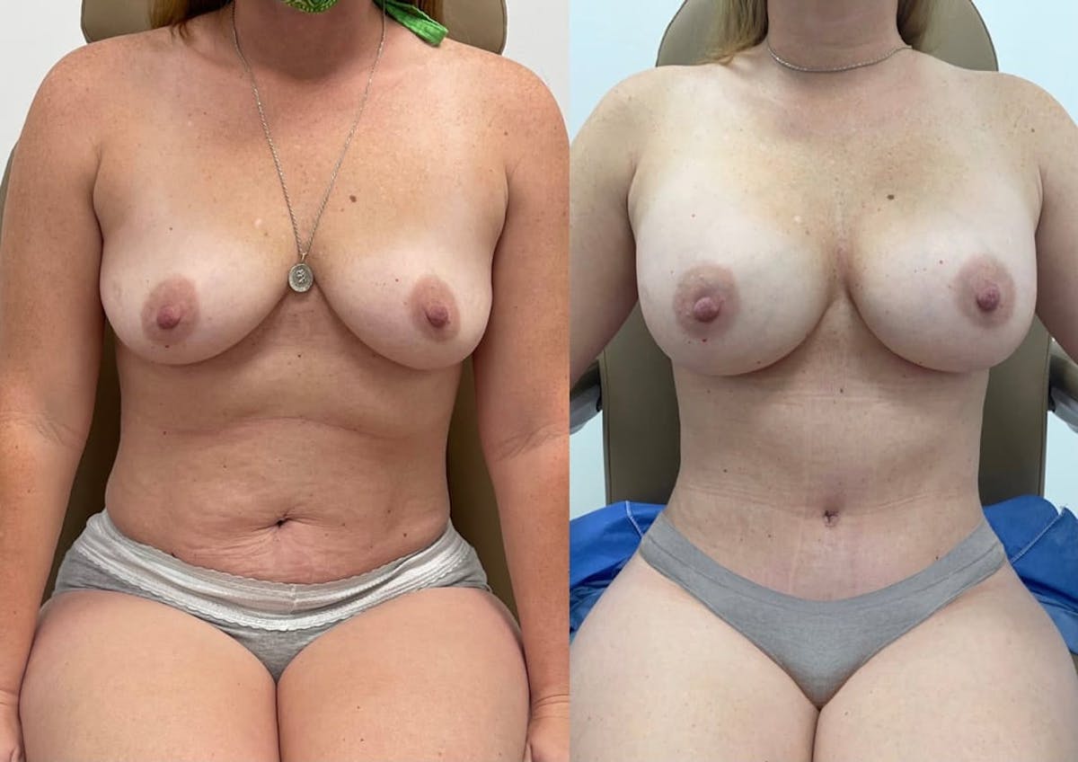 Tummy Tuck Before & After Gallery - Patient 580896 - Image 1