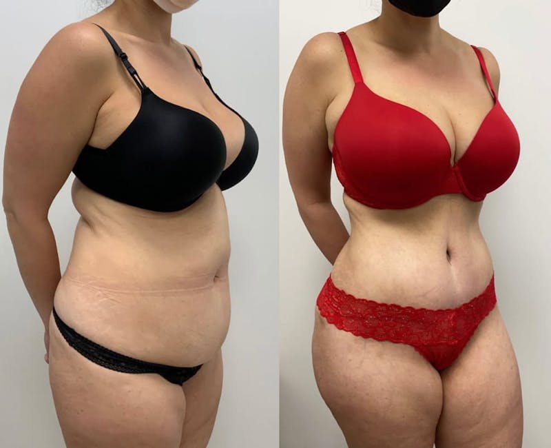 Tummy Tuck Before & After Gallery - Patient 269720 - Image 1