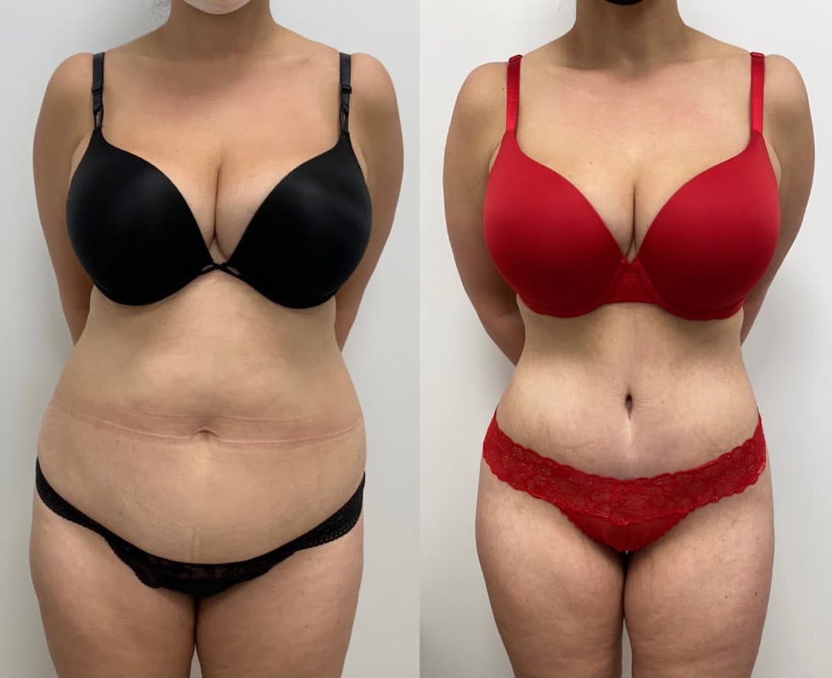 Tummy Tuck Before & After Gallery - Patient 269720 - Image 2