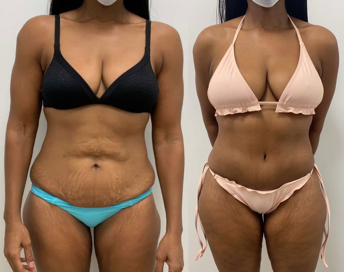 Tummy Tuck Before & After Gallery - Patient 350635 - Image 1