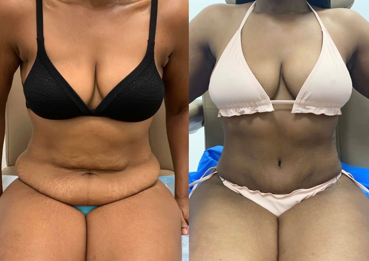 Tummy Tuck Before & After Gallery - Patient 350635 - Image 2