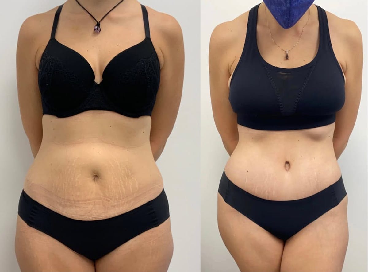 Tummy Tuck Before & After Gallery - Patient 246925 - Image 1