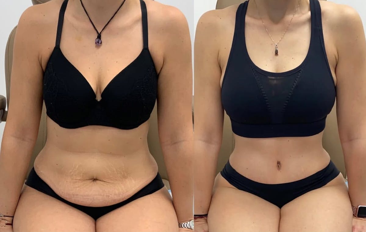 Tummy Tuck Before & After Gallery - Patient 246925 - Image 2