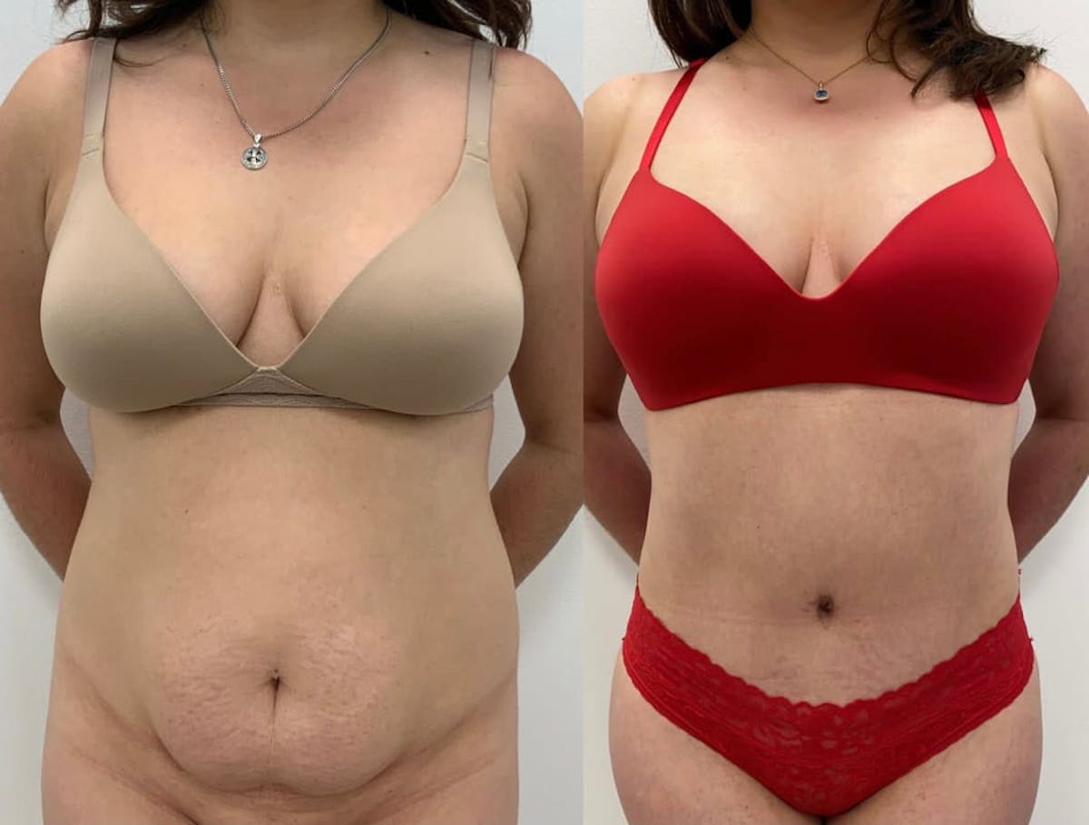 Tummy Tuck Before & After Gallery - Patient 342382 - Image 1
