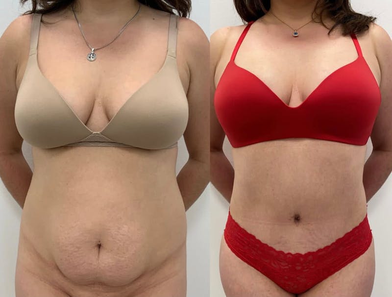 Tummy Tuck Before & After Gallery - Patient 342382 - Image 1
