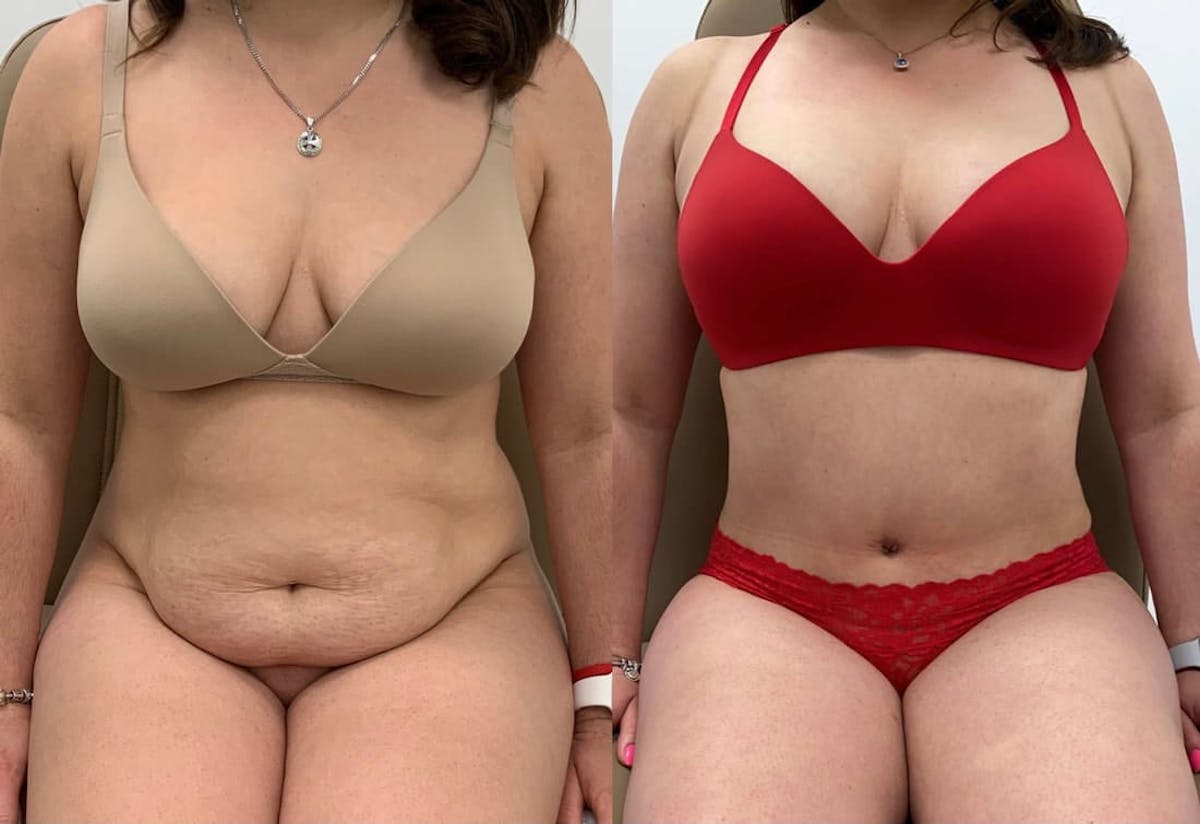 Tummy Tuck Before & After Gallery - Patient 342382 - Image 2