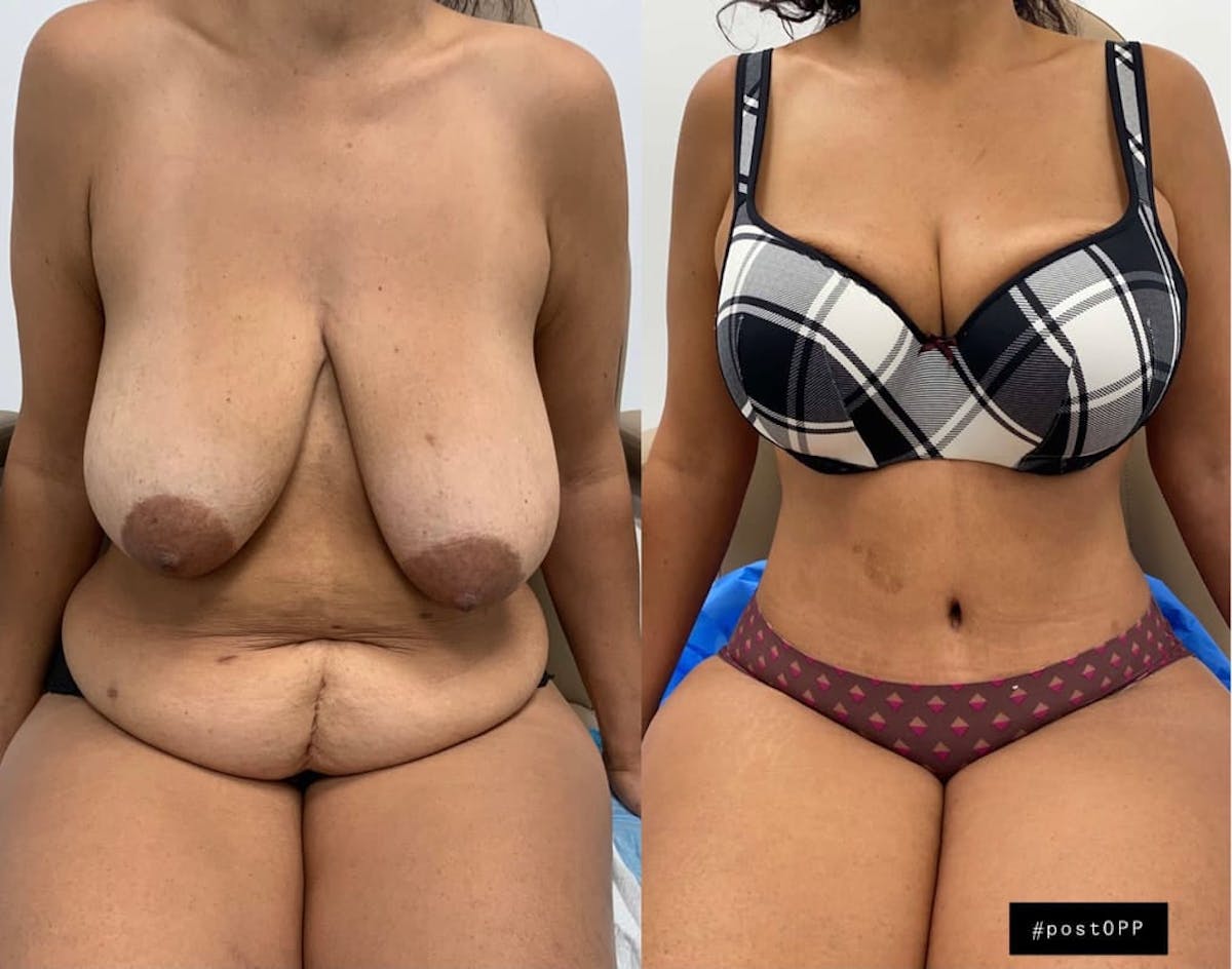 Tummy Tuck Before & After Gallery - Patient 341188 - Image 1