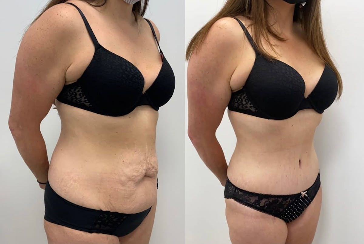 Tummy Tuck Before & After Gallery - Patient 198284 - Image 1