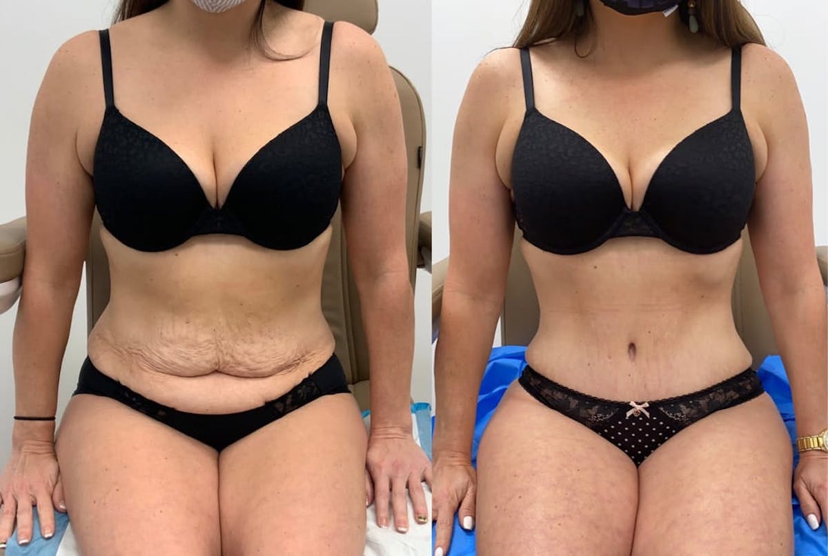 Tummy Tuck Before & After Gallery - Patient 198284 - Image 2