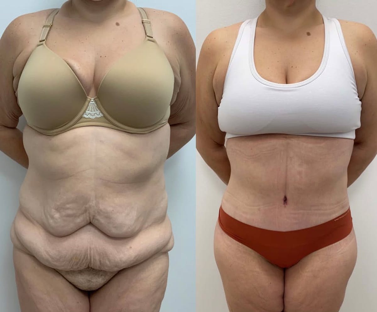 Tummy Tuck Before & After Gallery - Patient 390246 - Image 1