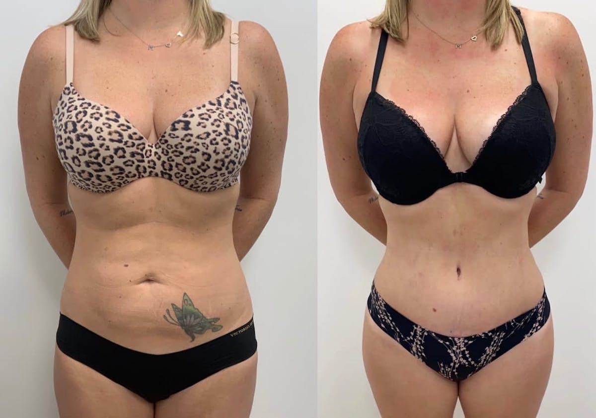 Tummy Tuck Before & After Gallery - Patient 117766 - Image 1