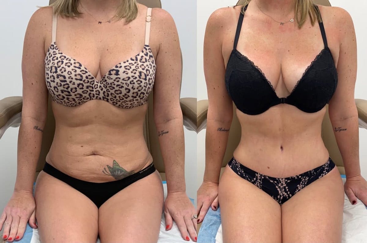 Tummy Tuck Before & After Gallery - Patient 117766 - Image 2