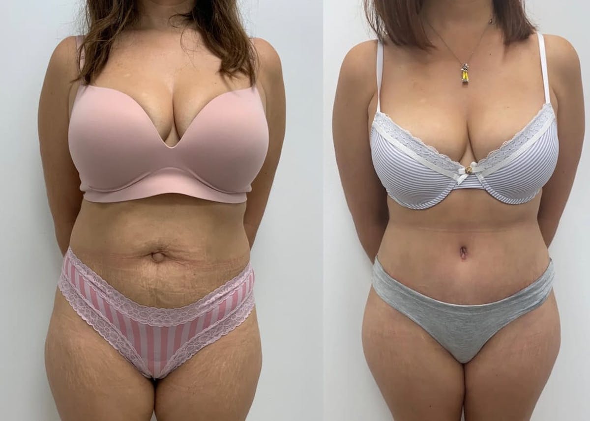 Tummy Tuck Before & After Gallery - Patient 419642 - Image 1