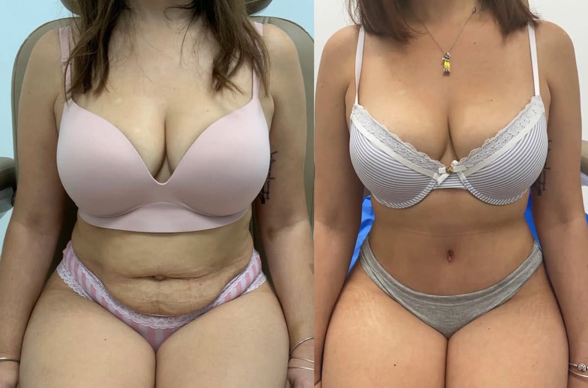 Tummy Tuck Before & After Gallery - Patient 419642 - Image 2