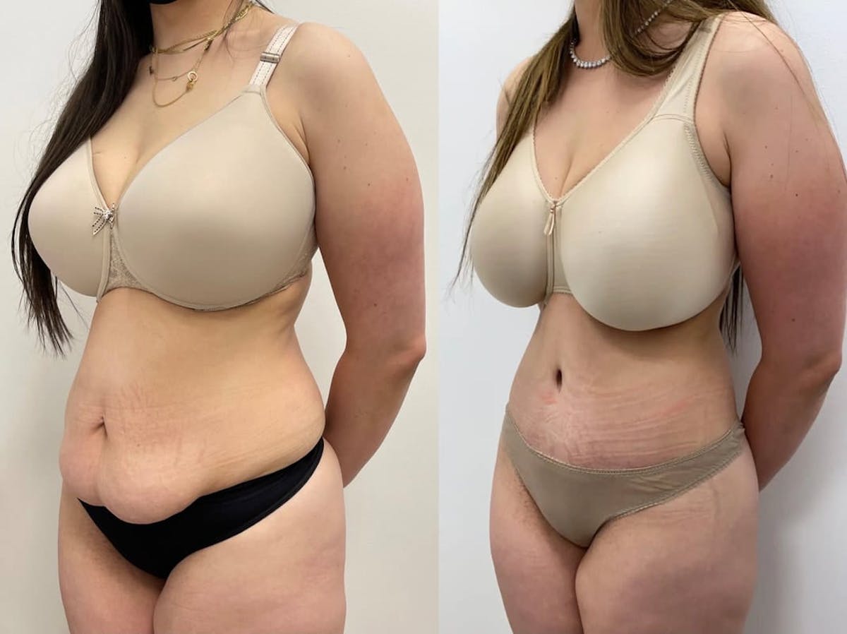 Tummy Tuck Before & After Gallery - Patient 406312 - Image 1