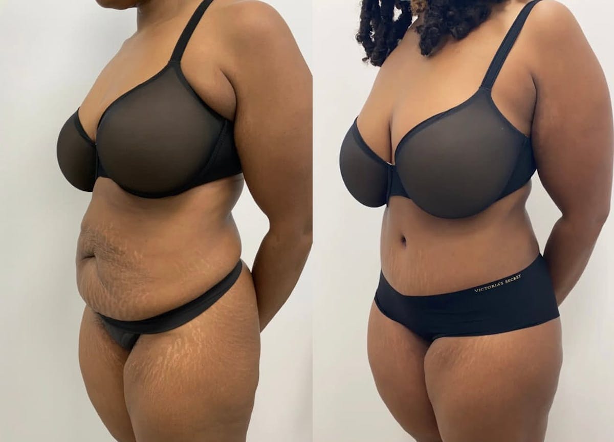 Tummy Tuck Before & After Gallery - Patient 954380 - Image 1