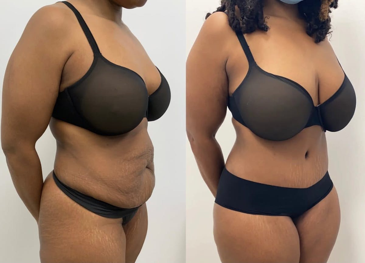 Tummy Tuck Before & After Gallery - Patient 954380 - Image 2