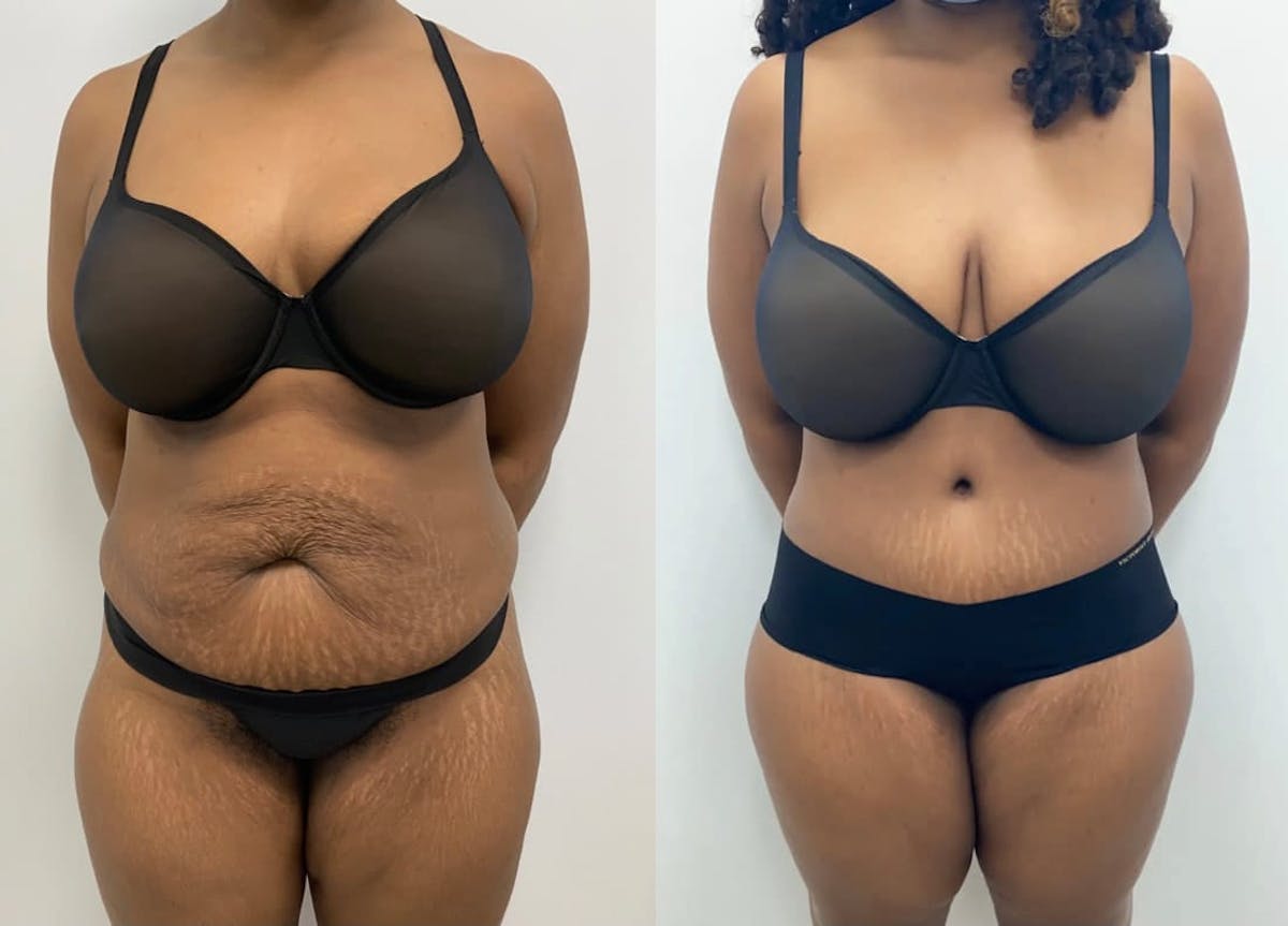 Tummy Tuck Before & After Gallery - Patient 954380 - Image 3