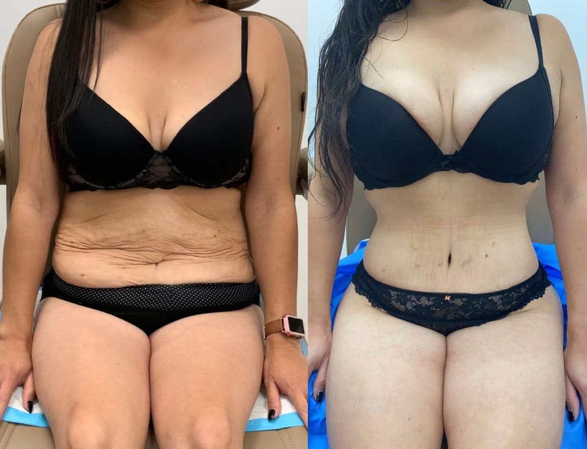 Tummy Tuck Before & After Gallery - Patient 176989 - Image 1