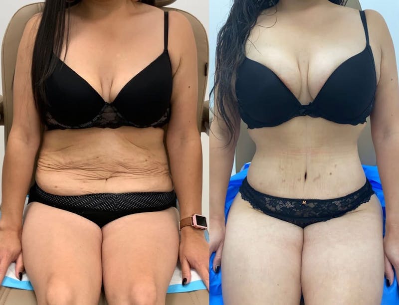 Tummy Tuck Before & After Gallery - Patient 176989 - Image 1