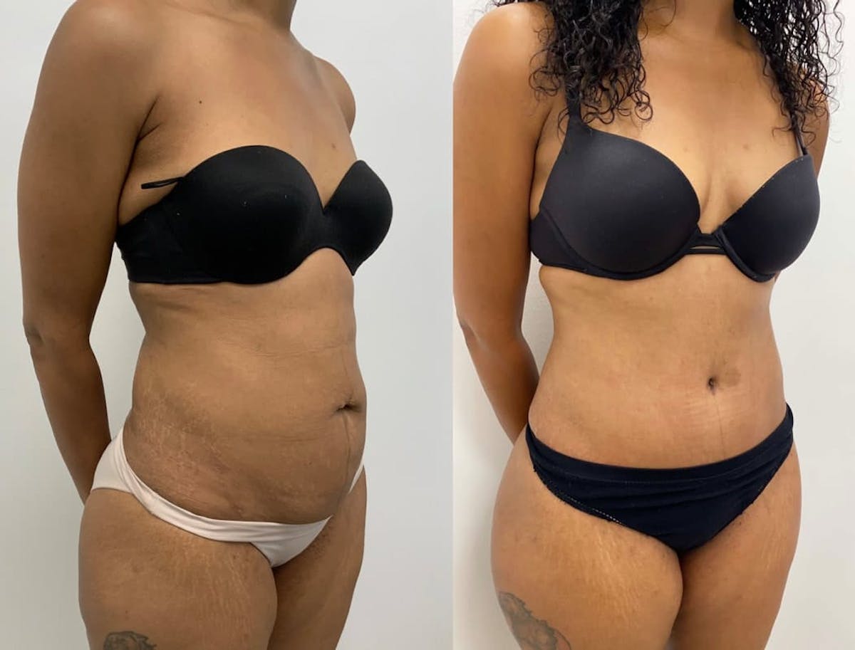 Tummy Tuck Before & After Gallery - Patient 140899 - Image 1