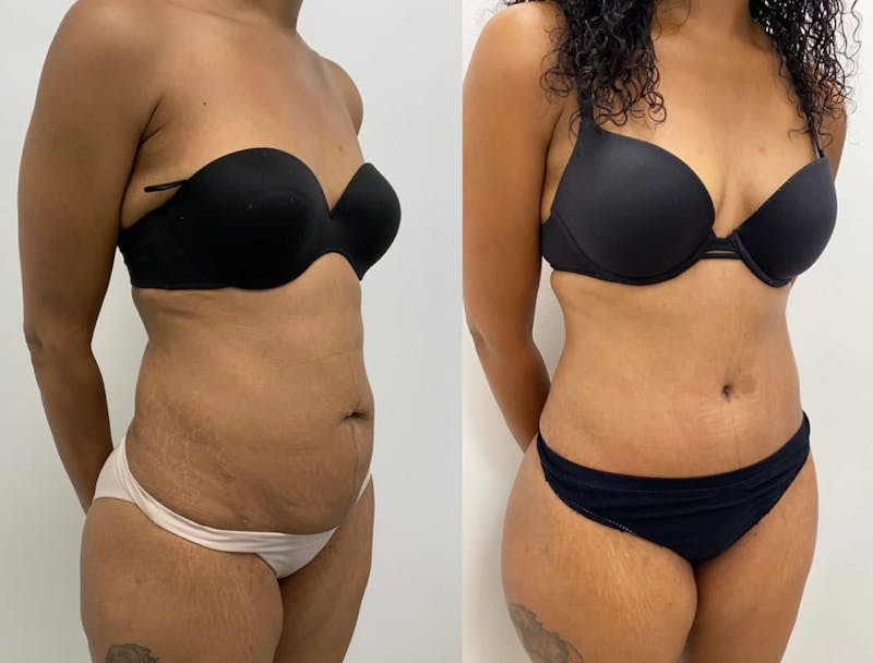 Tummy Tuck Before & After Gallery - Patient 140899 - Image 1
