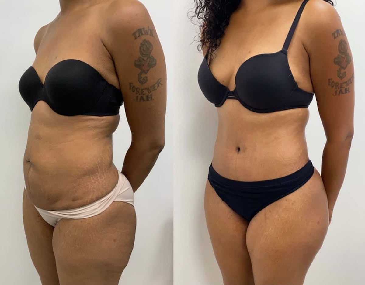 Tummy Tuck Before & After Gallery - Patient 140899 - Image 2