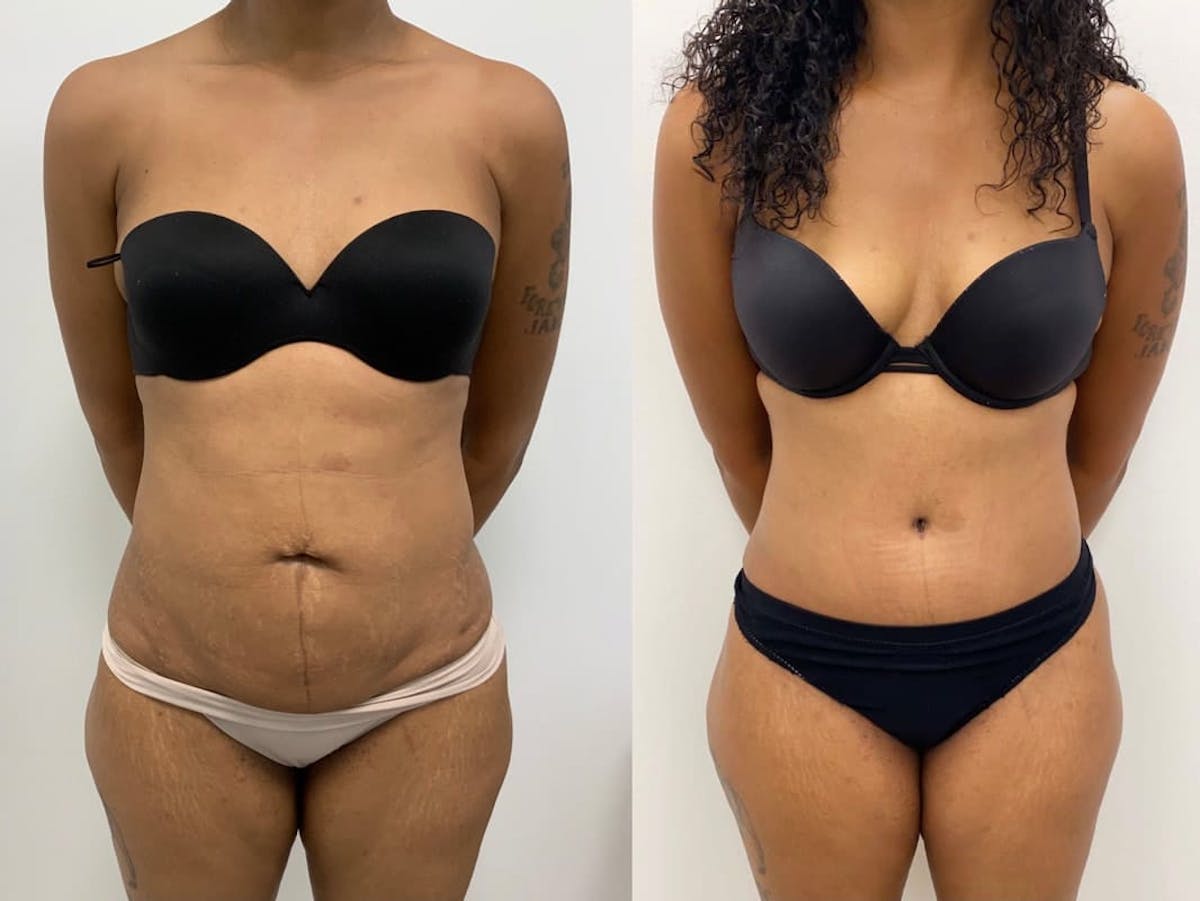 Tummy Tuck Before & After Gallery - Patient 140899 - Image 3