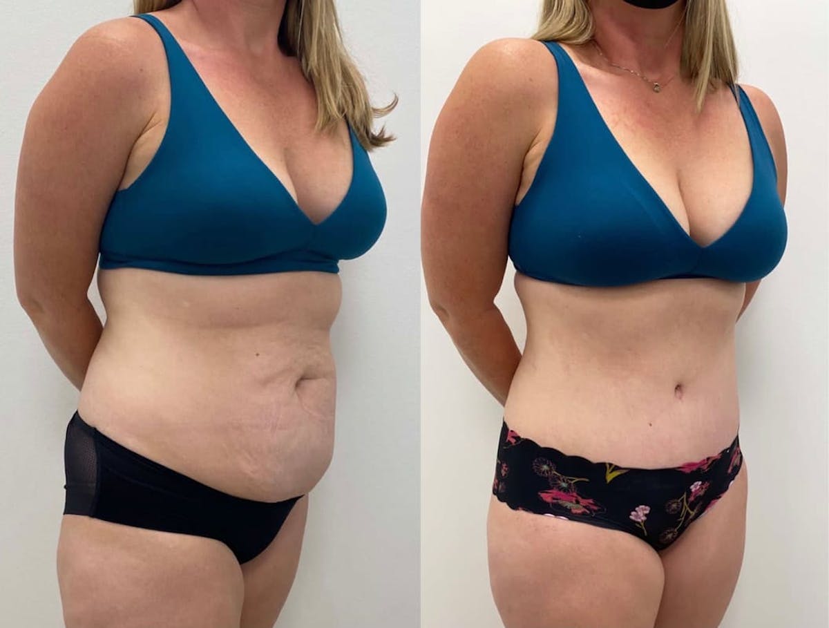 Tummy Tuck Before & After Gallery - Patient 277927 - Image 1