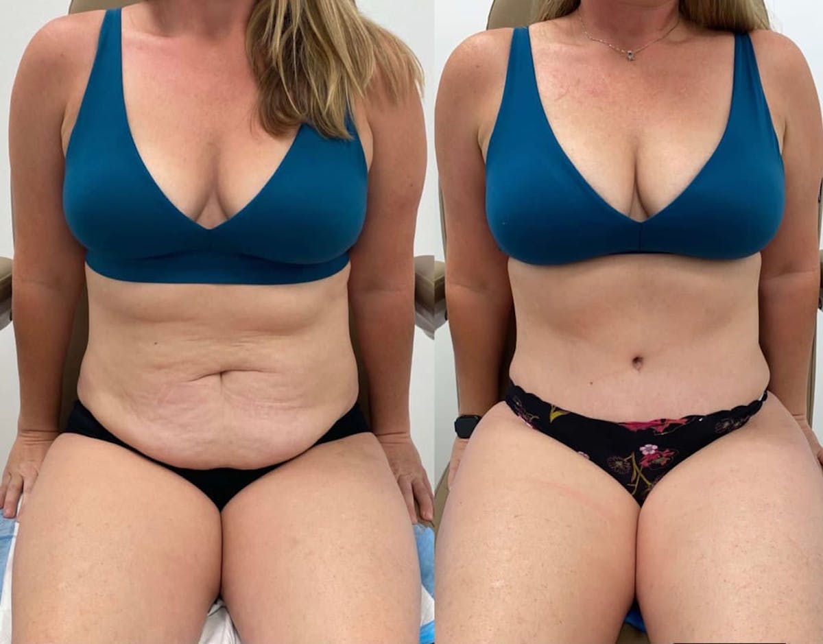 Tummy Tuck Before & After Gallery - Patient 277927 - Image 2