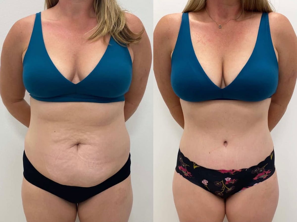 Tummy Tuck Before & After Gallery - Patient 277927 - Image 3
