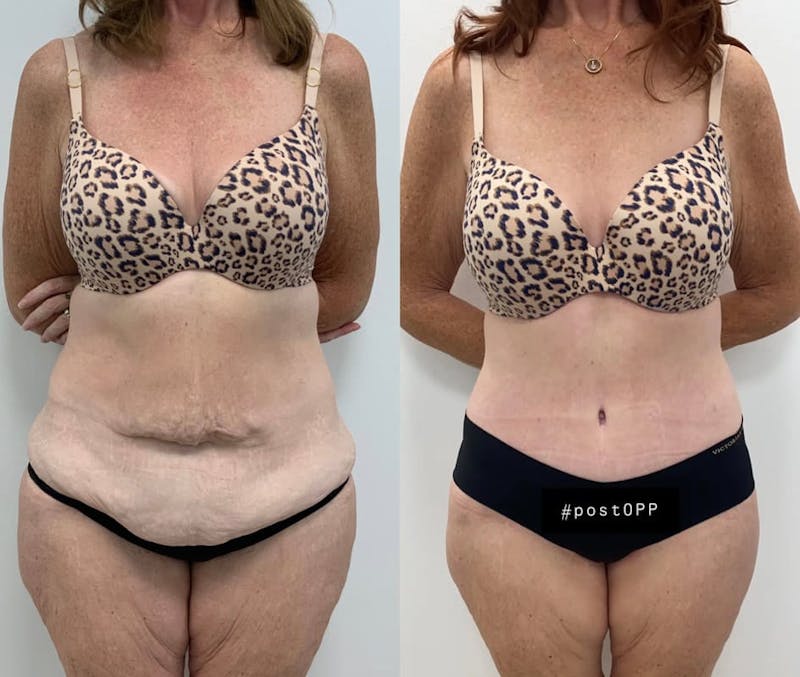 Tummy Tuck Before & After Gallery - Patient 469700 - Image 1