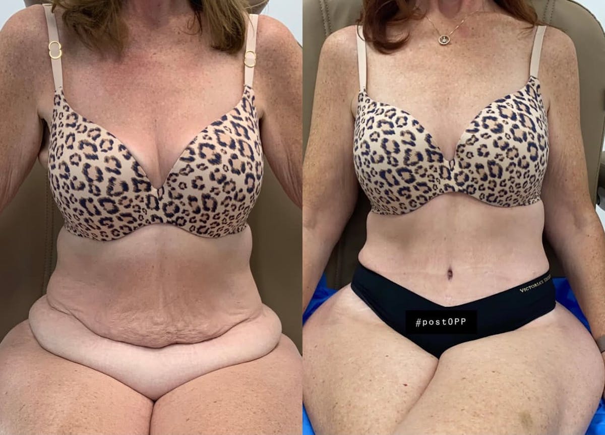Tummy Tuck Before & After Gallery - Patient 469700 - Image 2