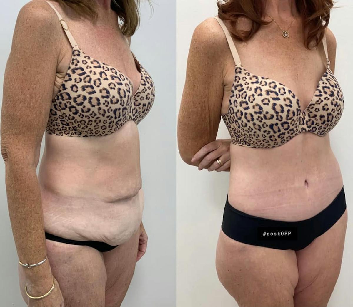 Tummy Tuck Before & After Gallery - Patient 469700 - Image 3