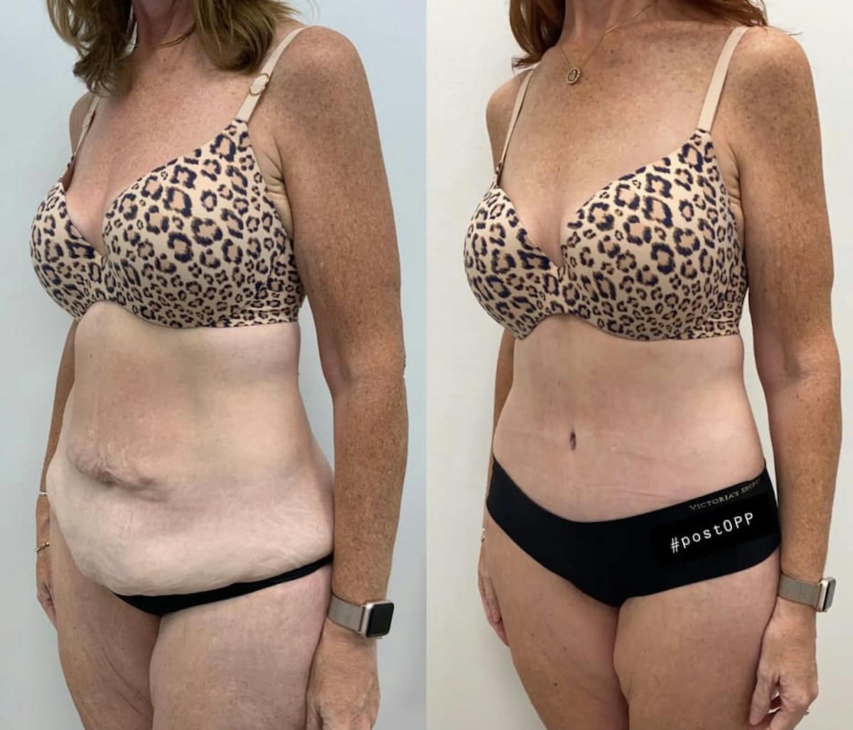 Tummy Tuck Before & After Gallery - Patient 469700 - Image 4