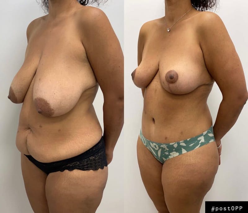 Tummy Tuck Before & After Gallery - Patient 427643 - Image 1